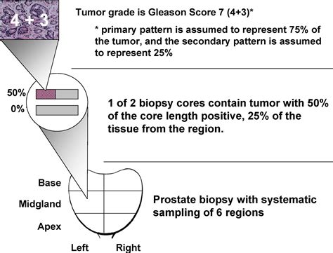 The proportion of prostate biopsy tissue with Gleason pattern 4 or 5 predicts for biochemical ...