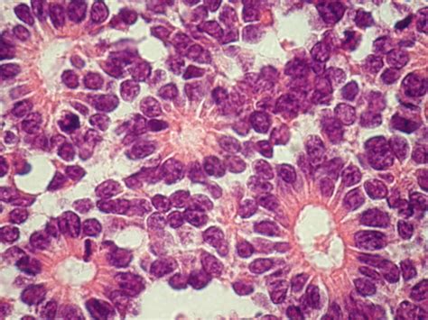 Review of Retinoblastoma - American Academy of Ophthalmology