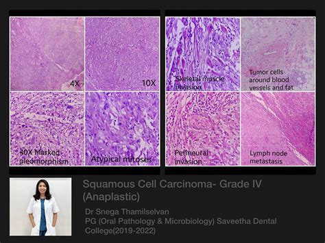 Anaplastic SCC — ORAL PATHOLOGY-SAVEETHA
