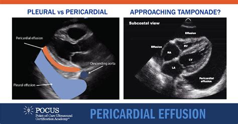 Light's Criteria For Pericardial Effusion at Blake Corlis blog