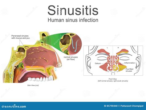 Purulent Nasal Discharge