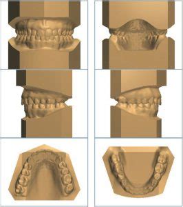 Image result for How to Take Study Models with Plaster Lab