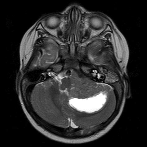 Imaging Characteristics of Atypical Teratoid–Rhabdoid Tumor in Children Compared with ...