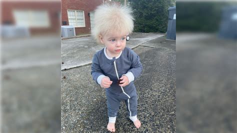 What's uncombable hair syndrome: Child in America diagnosed with the ...