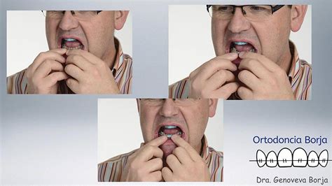 Ortodoncia Borja | ¿Eres músico y llevas brackets? Pues no machaques tu ...