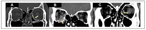 Orbital Implants in Orbital Fracture Reconstruction: A Ten-Year Series