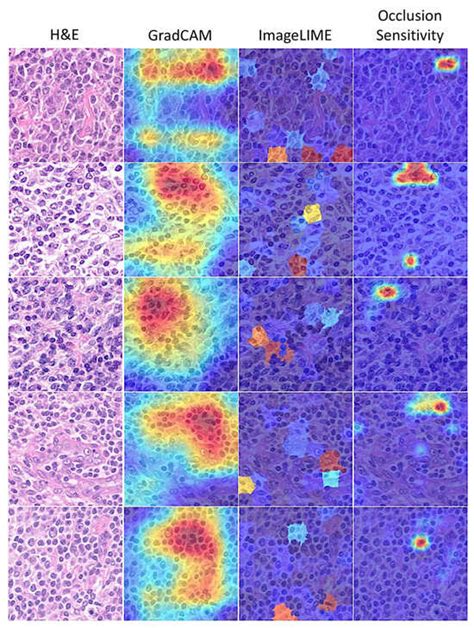 Histological Image Classification Between Follicular Lymphoma and ...