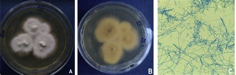 Drug-Resistant Trichophyton Indotineae in India. I UPSC