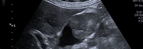 CA GALL BLADDER – Case By Dr. Nitin Jadhav