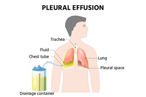 Pleural Effusion: Causes, Symptoms & Treatment