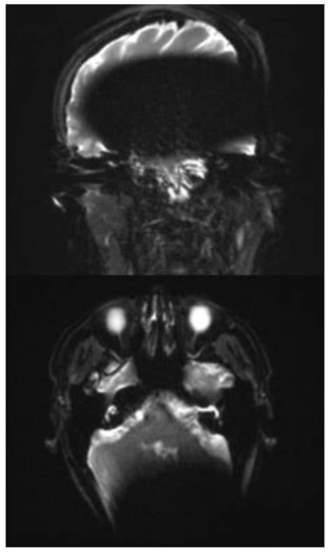 A Concept for MRI-Based Cholesteatoma Detection in Cochlea Implant ...