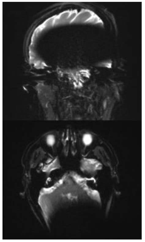 A Concept for MRI-Based Cholesteatoma Detection in Cochlea Implant ...