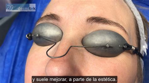 Laser entrecejo on sale