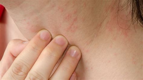 How Anxiety Medication Can Affect Your Skin | Clinikally