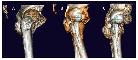 Femoral Anteversion in Total Hip Arthroplasty: Retrospective Comparison ...