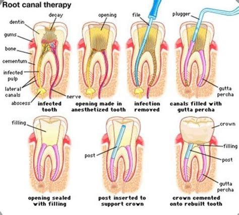 Dental Implants - Replace Missing Tooth | Dental Lounge