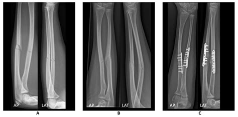 Broken Left Forearm X Ray