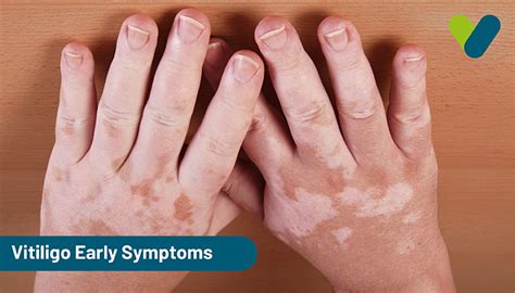 Vitiligo Early Symptoms: Detailed Guide on the Early Signs of Vitiligo ...