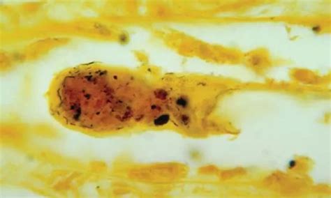 Leptospira infection- potential cause of chronic kidney disease of ...