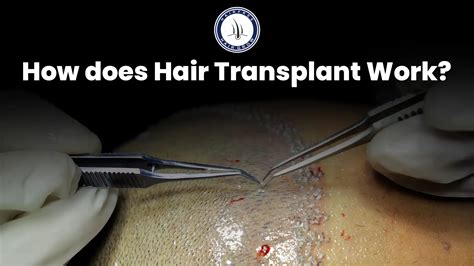 How Does Hair Transplant Work? Understand the Simple Process
