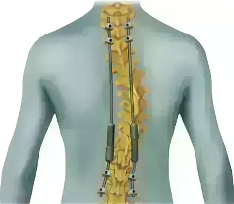 Dual Growing-Rods effective in treating Severe Early-Onset Scoliosis in ...
