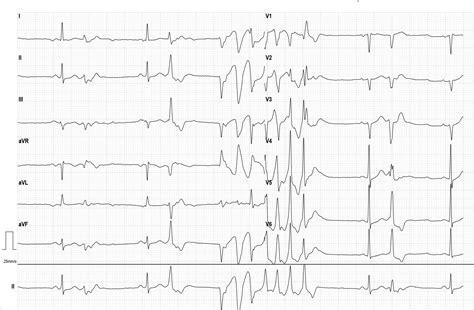 Polymorphic ventricular tachycardia | ECG Guru - Instructor Resources