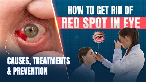 How To Get Rid Of Red Eye Vessel at Isla Lascelles blog