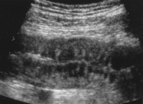 Bowel Wall Thickening on Transabdominal Sonography | AJR