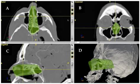 Skull-Base Surgery—A Narrative Review on Current Approaches and Future ...