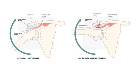 Shoulder Impingement Syndrome | Mr Soong Chua