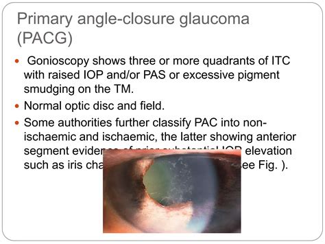 Primary angle closure glaucoma | PPTX