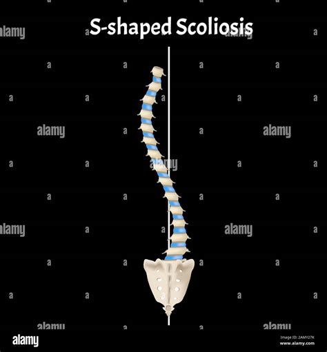 S-shaped scoliosis. Dextroscoliosis. Levoscoliosis. Spinal curvature ...