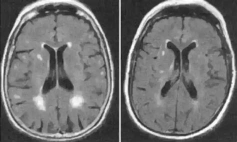 Diffusion tensor imaging parameters may help diagnose diabetic ...