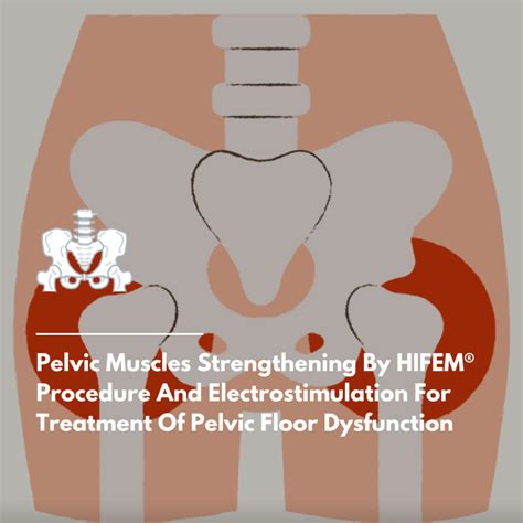 HIFEM® For Treatment Of Pelvic Floor Dysfunction