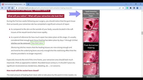 Image result for Healing Process of Tooth Extraction