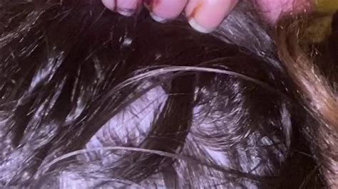 Scalp Parasites 的图像结果