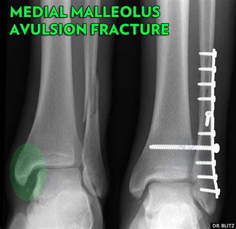 5 types de fractures de la malléole médiale de la cheville