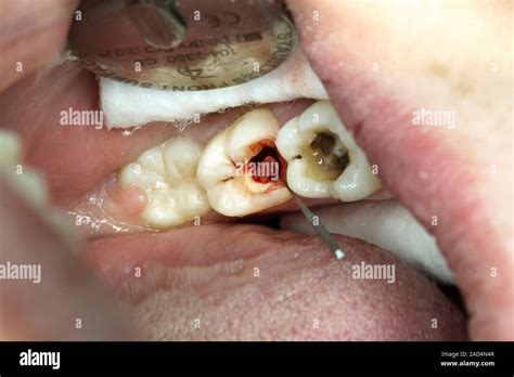Image result for Pulp Extraction Tooth