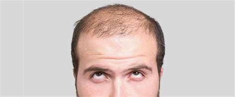 Hair Loss Due To Stress: Signs, Symptoms And Types