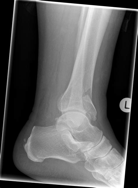 Pilon Fracture at Faith Fussell blog