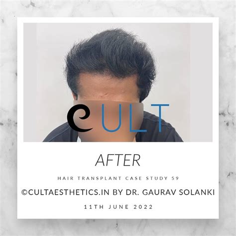 Hair Transplant Case Study 59 | Cult Aesthetics