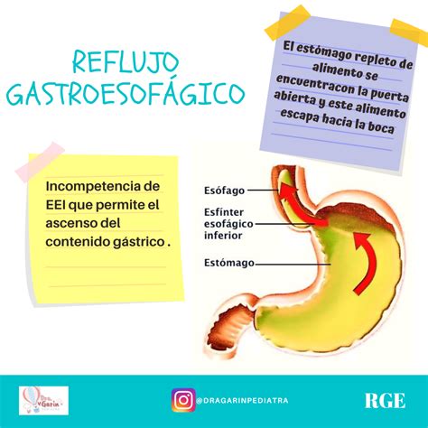 Reflujo gastroesofágico - Dra Garín Pediatra