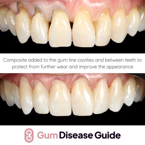 Using Composite Fillings For Gum Recession | Gum Disease Guide