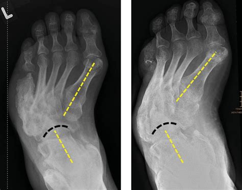 Schuh- und Prothesenversorgung beim diabetischen Fuß - Orthopädie ...