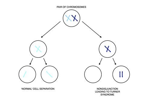 Turner Syndrome