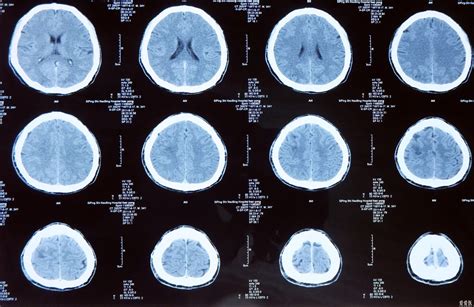 脑部检查核磁共振和CT哪个好？