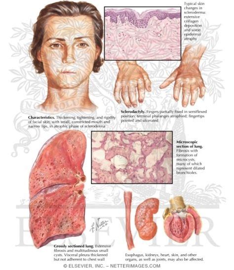 Image result for Diffuse Systemic Scleroderma