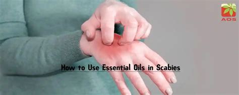 Essential Oils for Scabies Itching: Learn More | AOS Blog