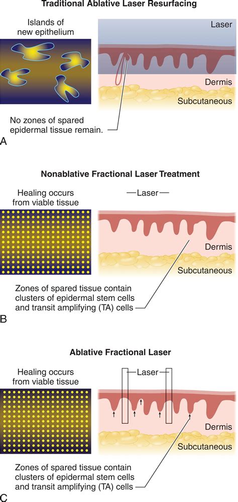Ablative Laser Skin Resurfacing - Clinical Tree