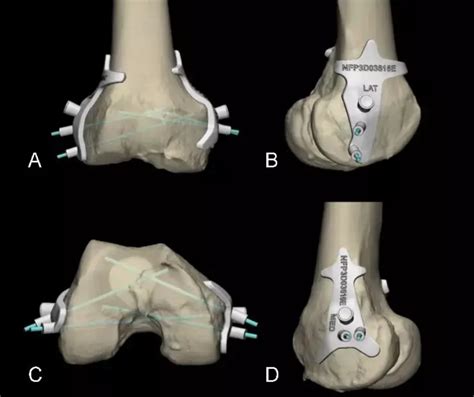3D printed patient specific instrumentation accurate tool to reproduce ...